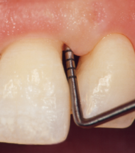 Parodontitis: met een pocketsonde wordt gemeten of de pocket verdiept is.